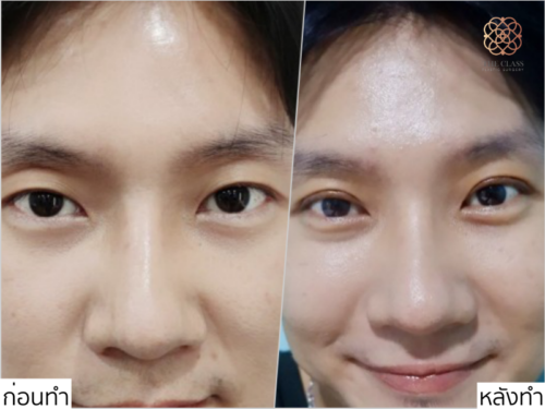ศัลยกรรมตาสองชั้น The Class Clinic