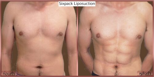 Lipo_sickpack-male3-front