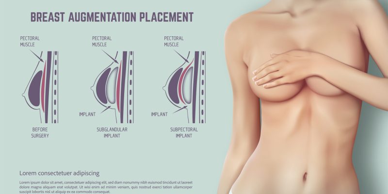 Breast Augmentation Placement