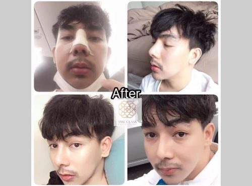 review nose4